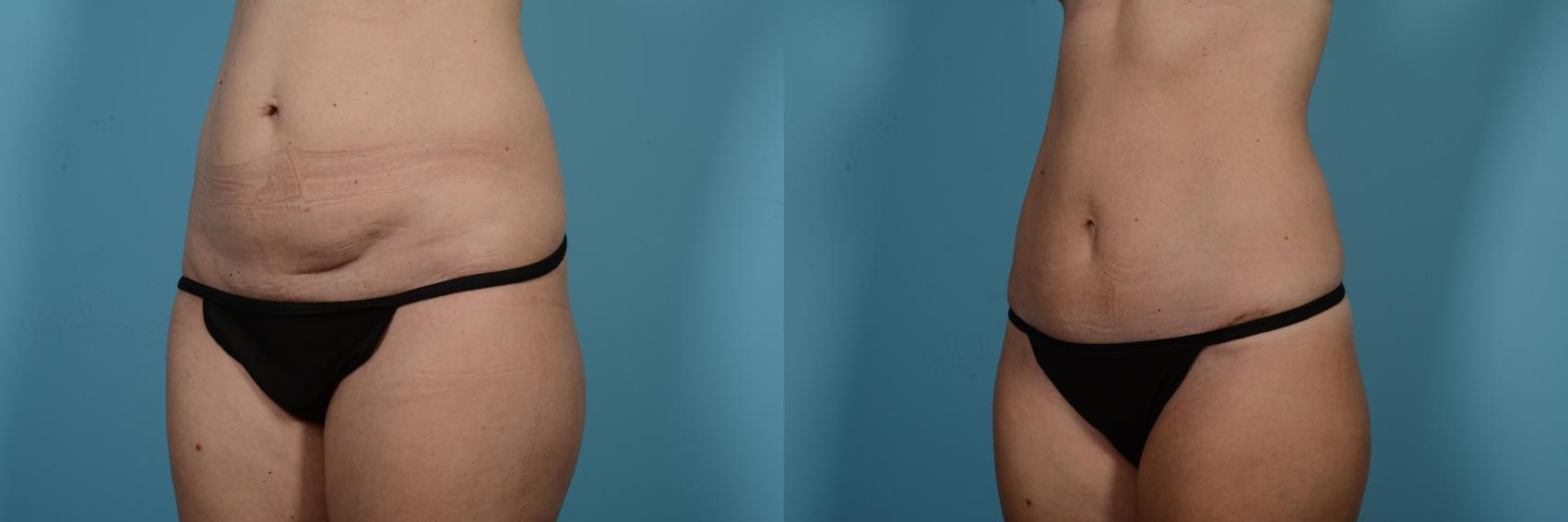 Before & After Tummy Tuck by Dr. Mustoe Case 550 Left Oblique View in Chicago, IL