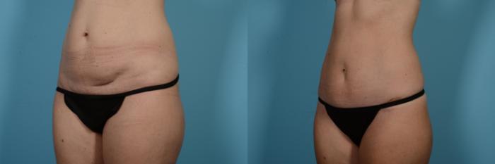 Before & After Tummy Tuck by Dr. Mustoe Case 550 Left Oblique View in Chicago, IL