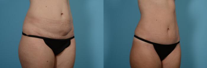 Before & After Tummy Tuck by Dr. Mustoe Case 550 Right Oblique View in Chicago, IL