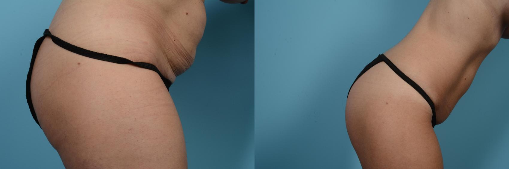 Before & After Tummy Tuck by Dr. Mustoe Case 550 Right Side View in Chicago, IL