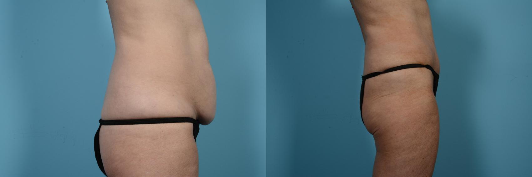 Before & After Tummy Tuck by Dr. Mustoe Case 552 View #3 View in Chicago, IL