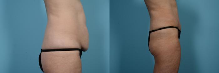 Before & After Tummy Tuck by Dr. Mustoe Case 552 View #3 View in Chicago, IL
