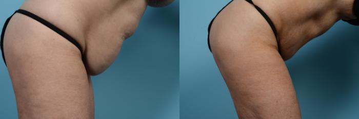 Before & After Tummy Tuck by Dr. Mustoe Case 552 View #4 View in Chicago, IL