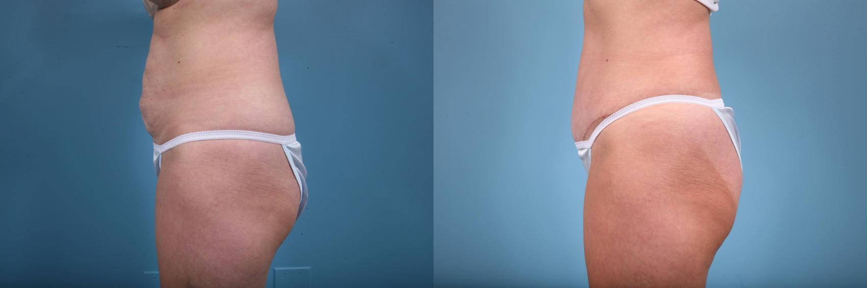 Before & After Tummy Tuck by Dr. Mustoe Case 64 View #2 View in Chicago, IL