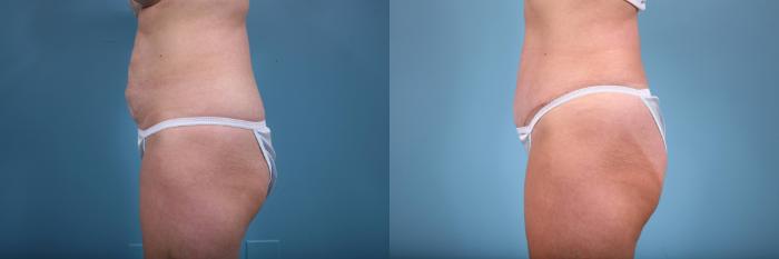 Before & After Tummy Tuck by Dr. Mustoe Case 64 View #2 View in Chicago, IL