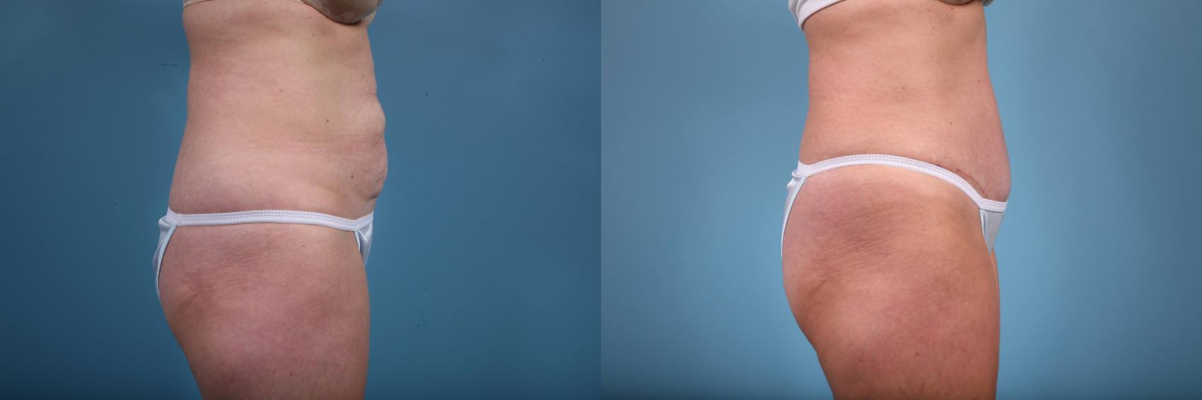 Before & After Tummy Tuck by Dr. Mustoe Case 64 View #3 View in Chicago, IL