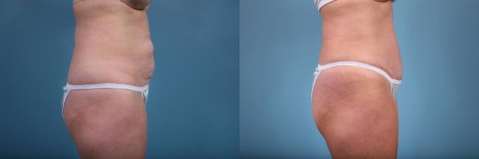 Before & After Tummy Tuck by Dr. Mustoe Case 64 View #3 View in Chicago, IL