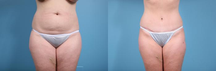 Before & After Tummy Tuck by Dr. Mustoe Case 73 View #1 View in Chicago, IL