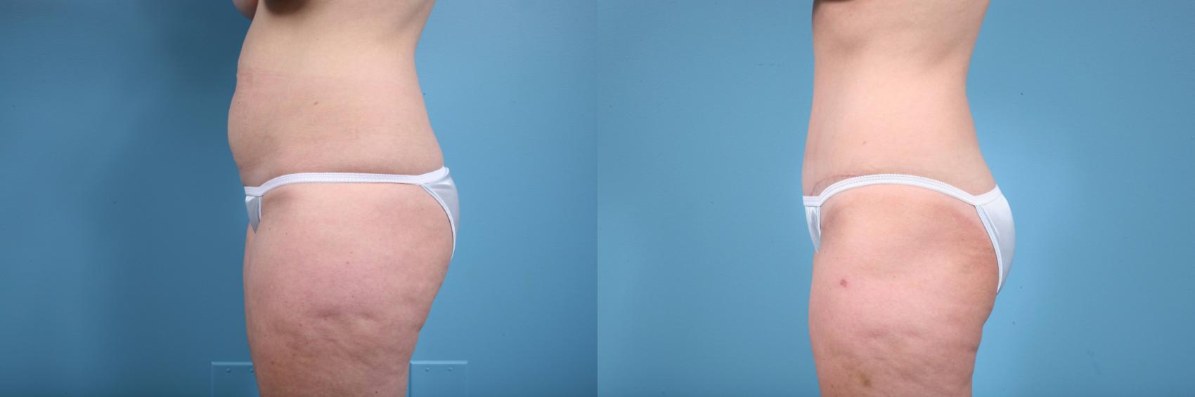 Before & After Tummy Tuck by Dr. Mustoe Case 73 View #2 View in Chicago, IL