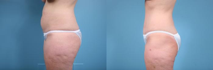Before & After Tummy Tuck by Dr. Mustoe Case 73 View #2 View in Chicago, IL