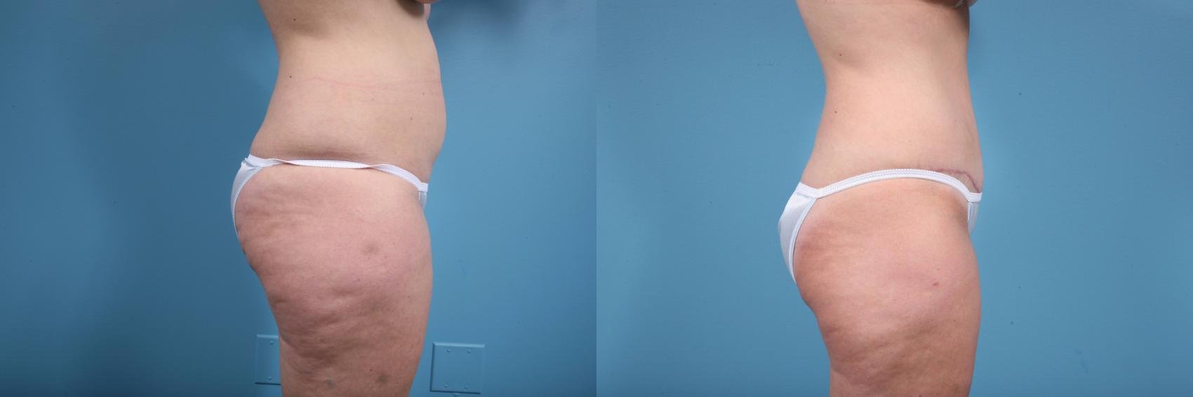 Before & After Tummy Tuck by Dr. Mustoe Case 73 View #3 View in Chicago, IL