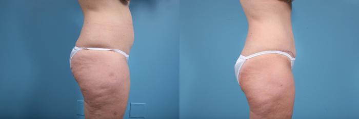 Before & After Tummy Tuck by Dr. Mustoe Case 73 View #3 View in Chicago, IL