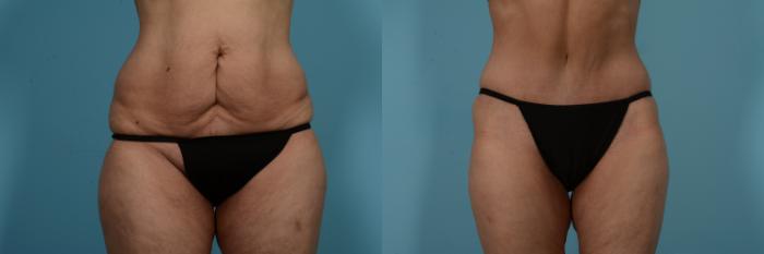Before & After Tummy Tuck by Dr. Mustoe Case 733 Front View in Chicago, IL