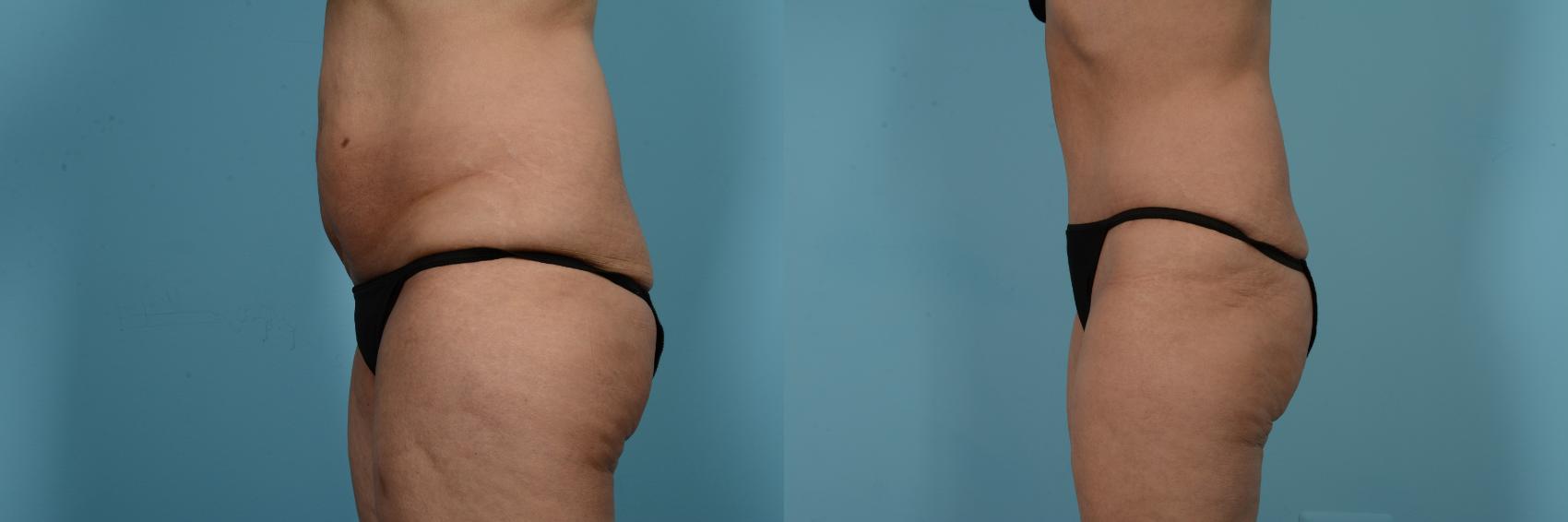 Before & After Tummy Tuck by Dr. Mustoe Case 733 Left Side View in Chicago, IL
