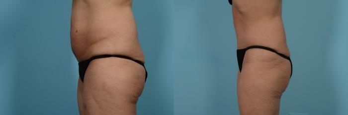 Before & After Tummy Tuck by Dr. Mustoe Case 733 Left Side View in Chicago, IL