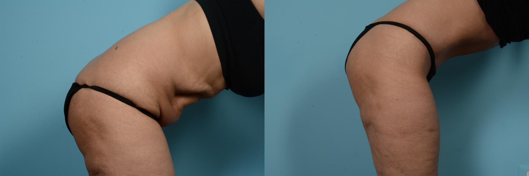 Before & After Tummy Tuck by Dr. Mustoe Case 733 Right Side View in Chicago, IL