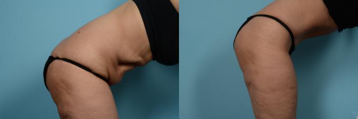 Before & After Tummy Tuck by Dr. Mustoe Case 733 Right Side View in Chicago, IL