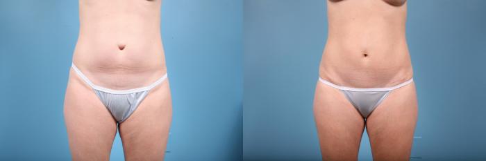 Before & After Tummy Tuck by Dr. Mustoe Case 75 View #1 View in Chicago, IL