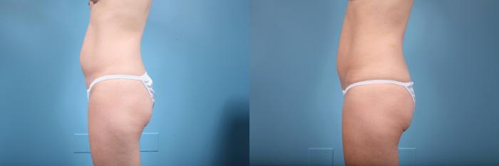Before & After Tummy Tuck by Dr. Mustoe Case 75 View #2 View in Chicago, IL