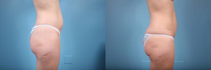Before & After Tummy Tuck by Dr. Mustoe Case 75 View #3 View in Chicago, IL