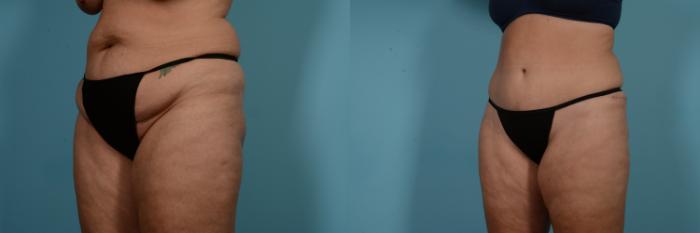 Before & After Tummy Tuck by Dr. Mustoe Case 769 Left Oblique View in Chicago, IL
