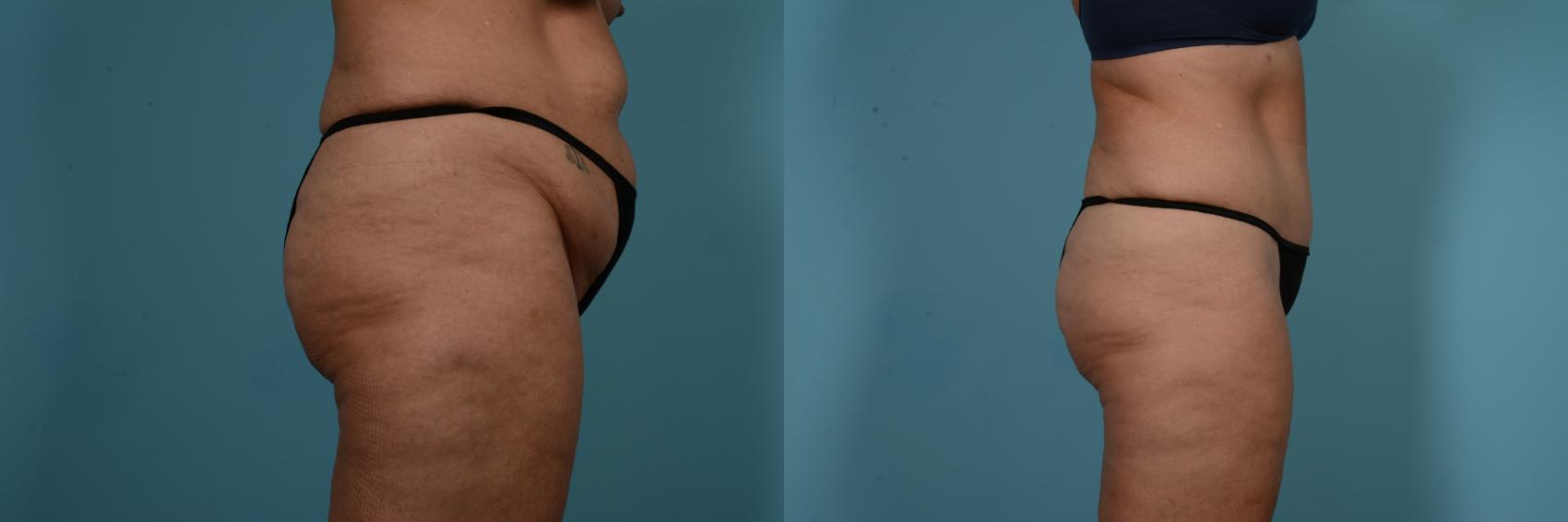 Before & After Tummy Tuck by Dr. Mustoe Case 769 Right Side View in Chicago, IL