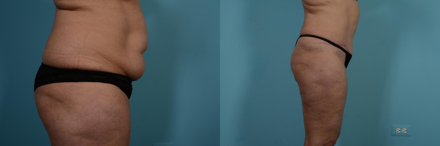 Before & After Tummy Tuck by Dr. Mustoe Case 774 Right Side View in Chicago, IL