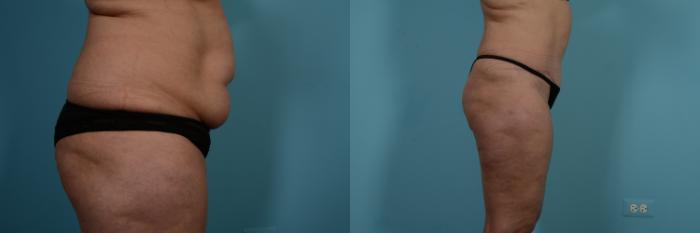 Before & After Tummy Tuck by Dr. Mustoe Case 774 Right Side View in Chicago, IL