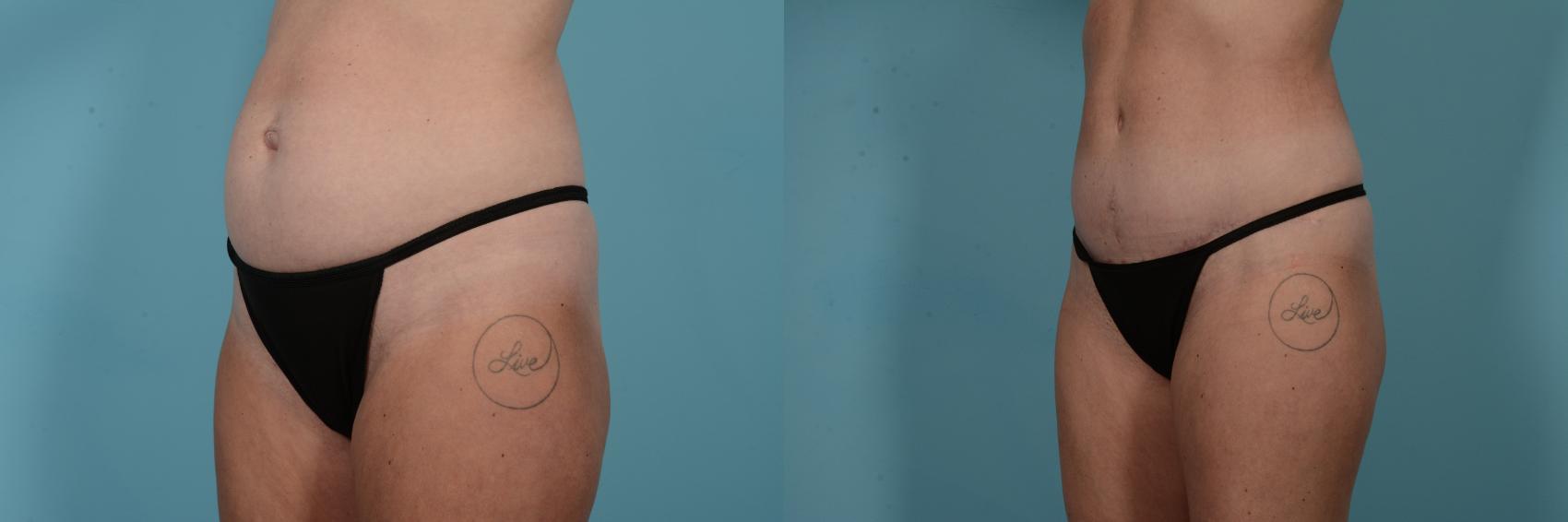Before & After Tummy Tuck by Dr. Mustoe Case 798 Left Oblique View in Chicago, IL