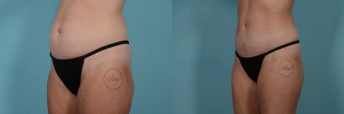Before & After Tummy Tuck by Dr. Mustoe Case 798 Left Oblique View in Chicago, IL