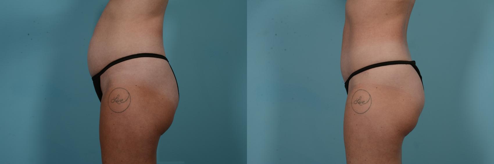 Before & After Tummy Tuck by Dr. Mustoe Case 798 Left Side View in Chicago, IL