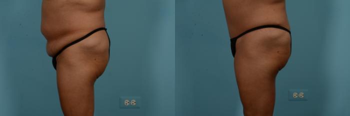 Before & After Tummy Tuck by Dr. Mustoe Case 824 Left Side View in Chicago, IL
