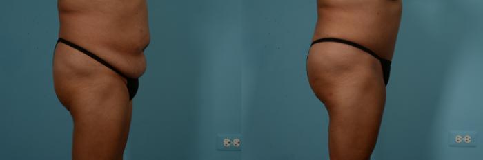 Before & After Tummy Tuck by Dr. Mustoe Case 824 Right Side View in Chicago, IL