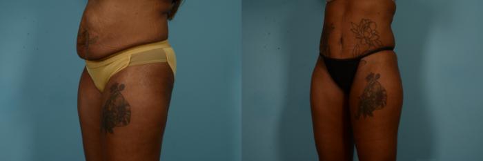 Before & After Tummy Tuck by Dr. Mustoe Case 840 Left Oblique View in Chicago, IL
