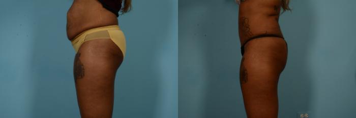 Before & After Tummy Tuck by Dr. Mustoe Case 840 Left Side View in Chicago, IL