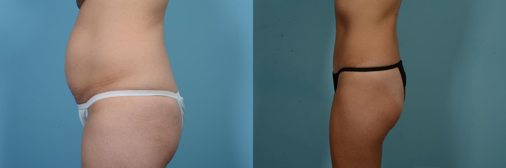 Before & After Tummy Tuck by Dr. Mustoe Case 842 Left Side View in Chicago, IL