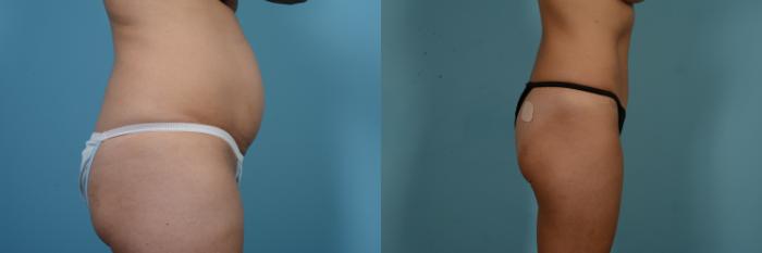 Before & After Tummy Tuck by Dr. Mustoe Case 842 Right Side View in Chicago, IL