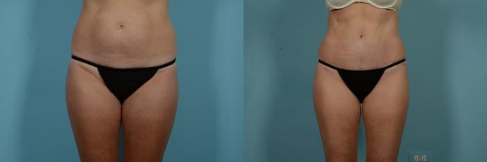 Before & After Tummy Tuck by Dr. Mustoe Case 971 Front View in Chicago, IL