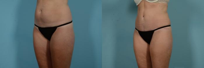 Before & After Tummy Tuck by Dr. Mustoe Case 971 Left Oblique View in Chicago, IL