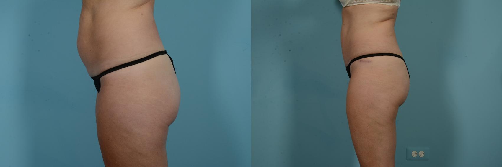 Before & After Tummy Tuck by Dr. Mustoe Case 971 Left Side View in Chicago, IL