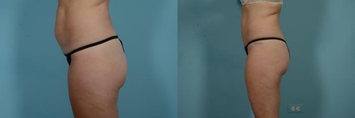Before & After Tummy Tuck by Dr. Mustoe Case 971 Left Side View in Chicago, IL