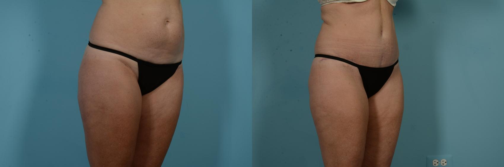 Before & After Tummy Tuck by Dr. Mustoe Case 971 Right Oblique View in Chicago, IL