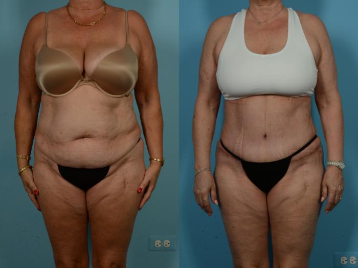 Before & After Tummy Tuck by Dr. Sinno Case 1065 Front View in Chicago, IL