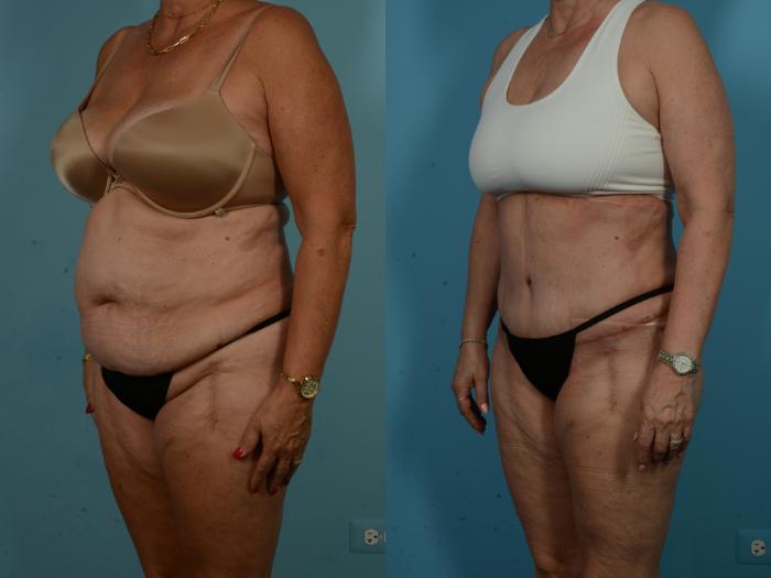 Before & After Tummy Tuck by Dr. Sinno Case 1065 Left Oblique View in Chicago, IL