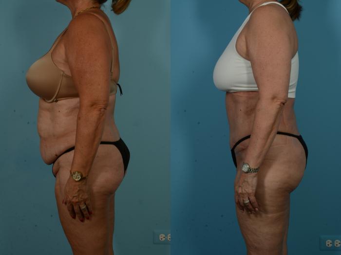 Before & After Tummy Tuck by Dr. Sinno Case 1065 Left Side View in Chicago, IL
