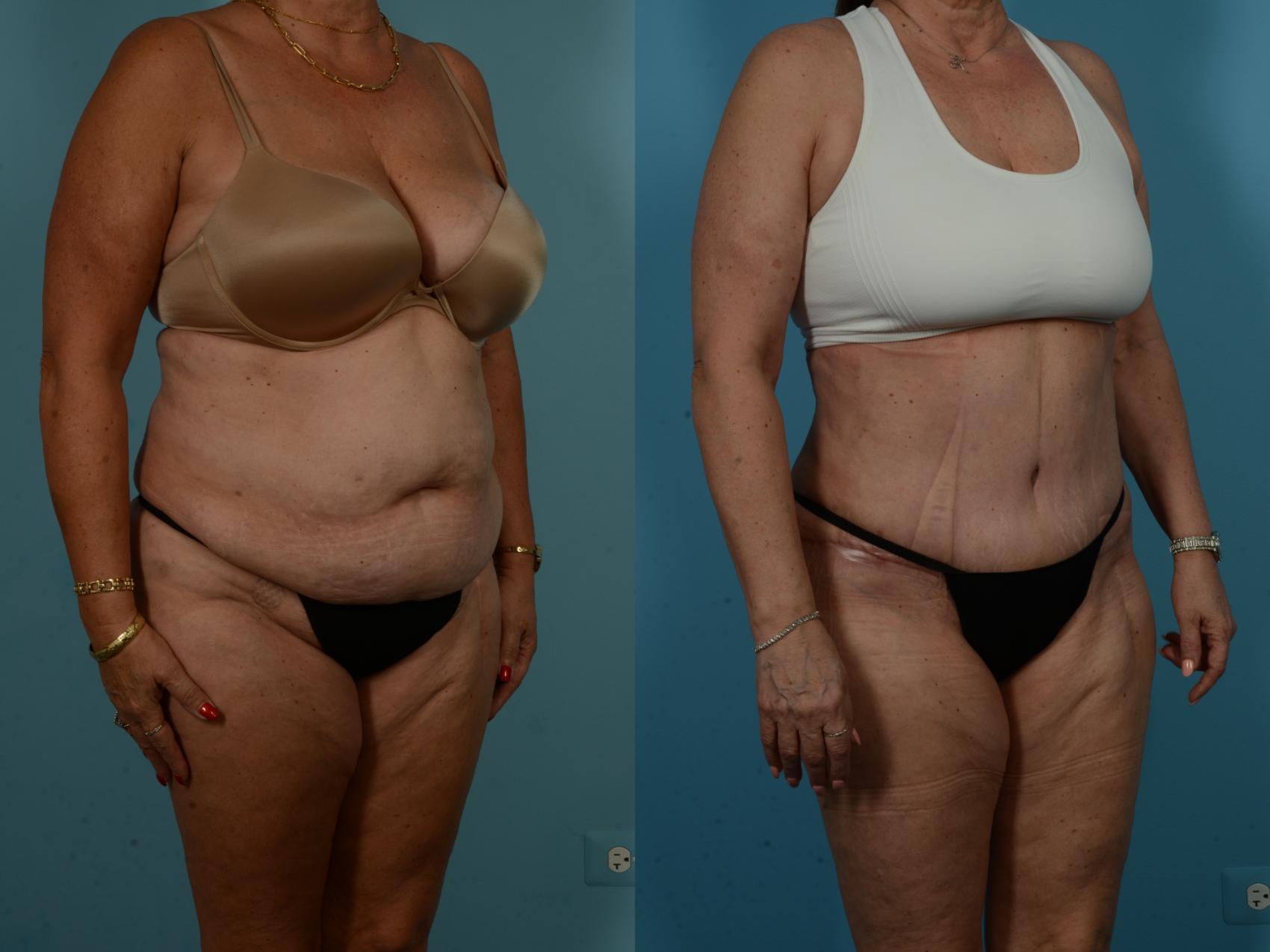 Before & After Tummy Tuck by Dr. Sinno Case 1065 Right Oblique View in Chicago, IL