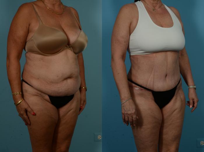 Before & After Tummy Tuck by Dr. Sinno Case 1065 Right Oblique View in Chicago, IL