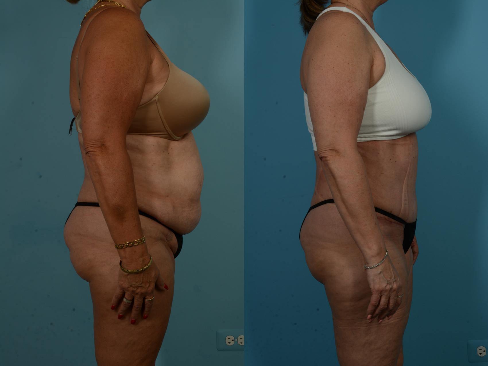 Before & After Tummy Tuck by Dr. Sinno Case 1065 Right Side View in Chicago, IL