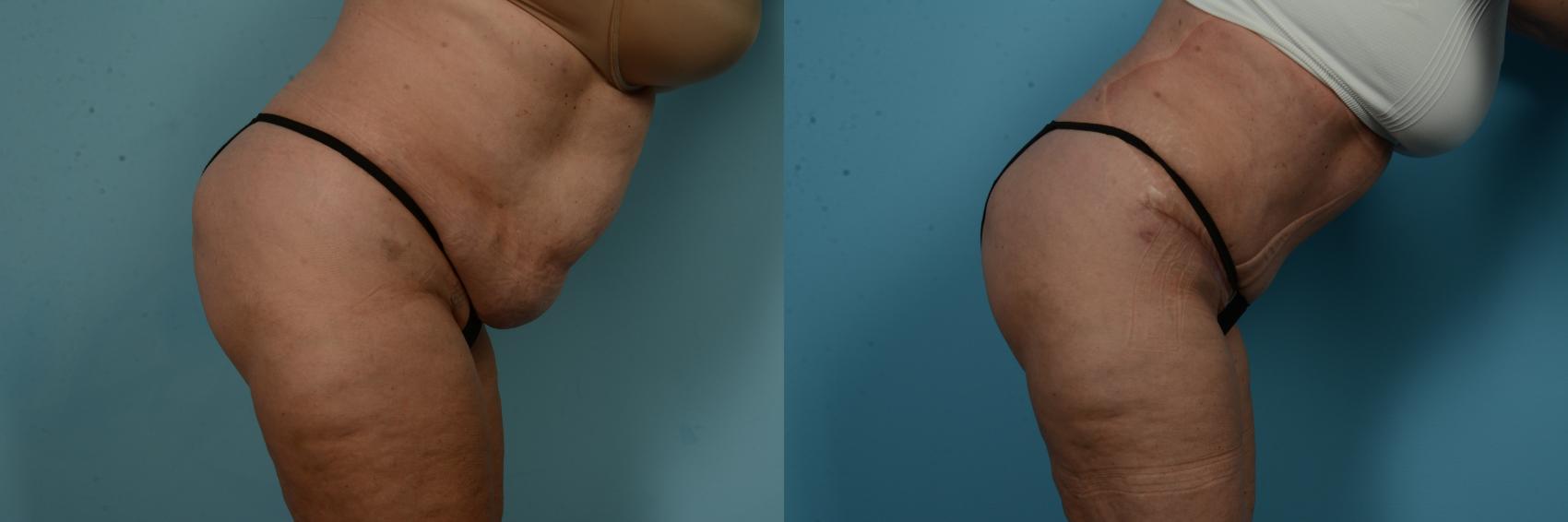 Before & After Tummy Tuck by Dr. Sinno Case 1065 Right Side Forward View in Chicago, IL