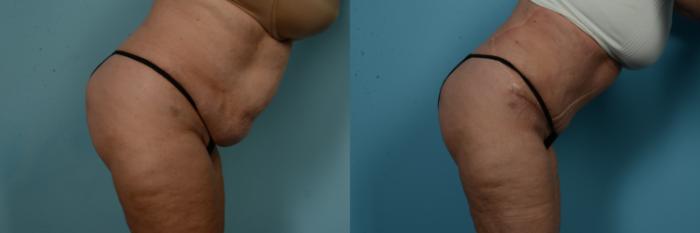 Before & After Tummy Tuck by Dr. Sinno Case 1065 Right Side Forward View in Chicago, IL
